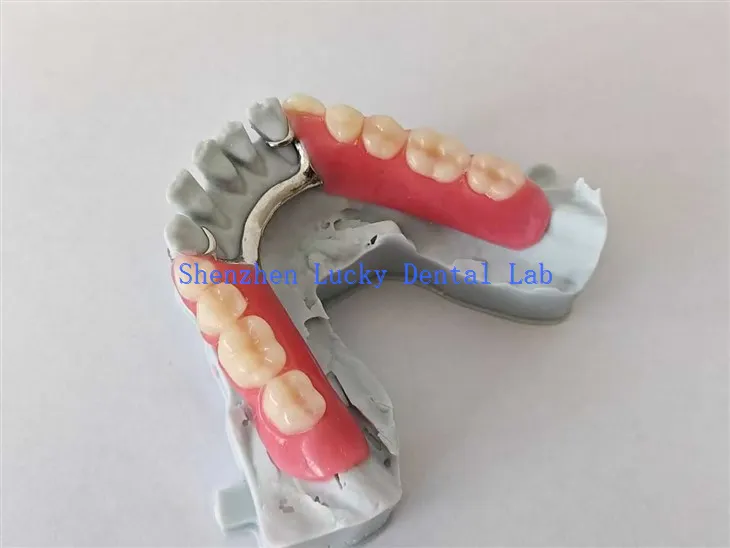 3Д штампање делимичне акрилне протезе са металним оквиром Покушајте у зубарској лабораторији