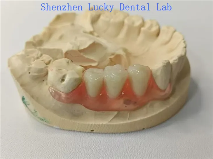 Естетски зубни валпласт флиппер