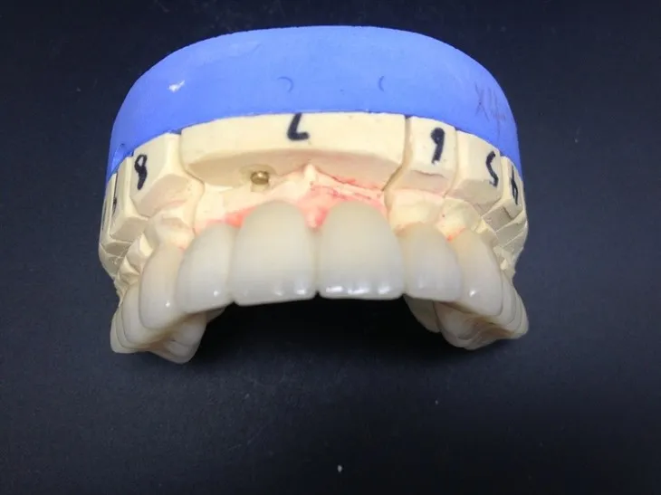 Високо прецизна зубна круница од потпуно керамике од цирконијума