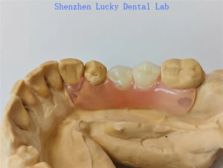 Дјеломична флексибилна стоматолошка протеза са валпластским стезаљкама