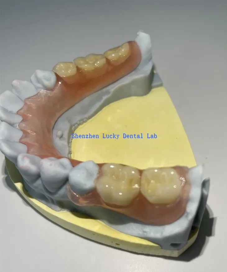Дјеломична флексибилна протеза