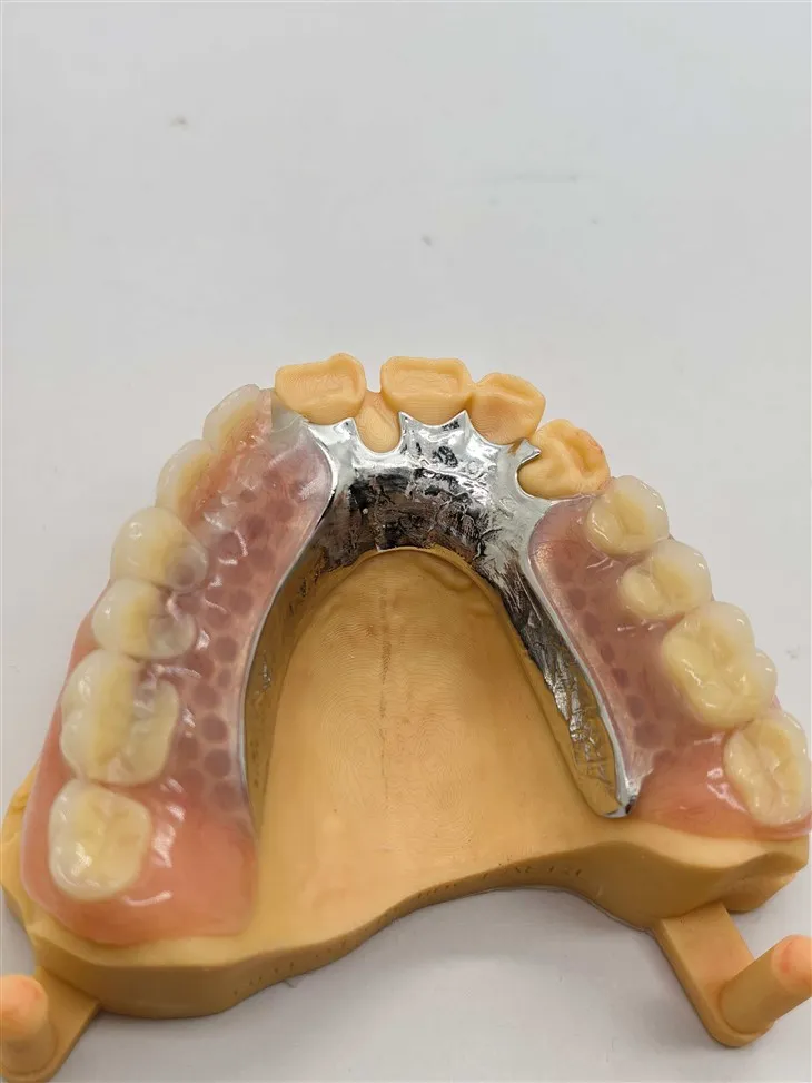 Поуздана протеза са делимичним металним оквиром