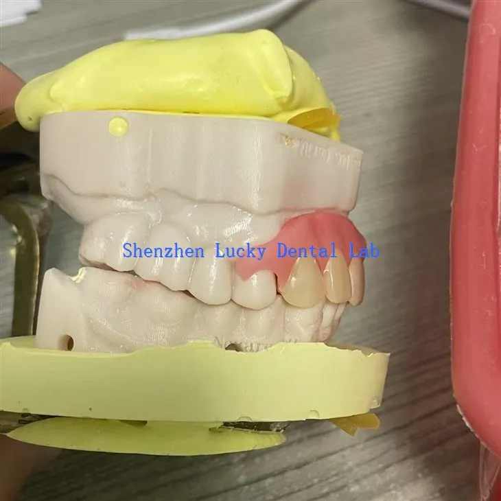 Удобна делимична флексибилна протеза Пробајте у зубарској лабораторији