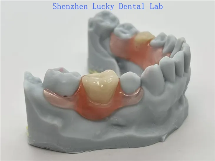 Валпласт® делимичности са флексибилним копчицама